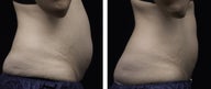 LIPOSONIX