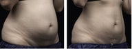 Liposonix