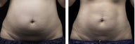 LIPOSONIX