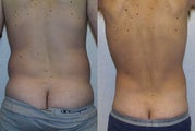 Liposuction