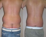 Liposuction