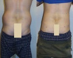 Liposuction