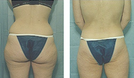 Liposuction