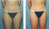 Liposuction