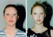 Liposuction
