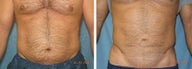 Liposuction tummy