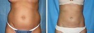Liposuction tummy