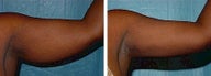 Liposuction arms