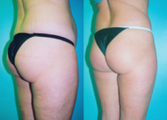 Tummy Tuck with Liposuction