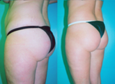 Tummy Tuck with Liposuction