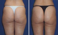 Liposuction