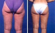 Liposuction