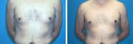 Liposuction