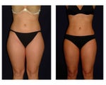 Liposuction