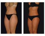 Liposuction