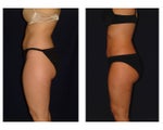 Liposuction