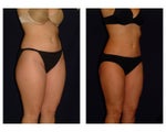 Liposuction