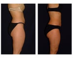 Liposuction