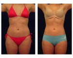 Liposuction