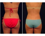Liposuction
