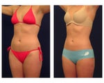 Liposuction