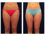 Liposuction