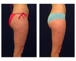 Liposuction