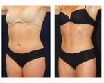 Liposuction