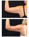Liposuction