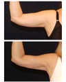 Liposuction