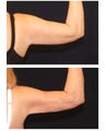 Liposuction