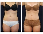 Liposuction