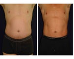 Liposuction