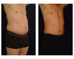 Liposuction