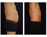 Liposuction