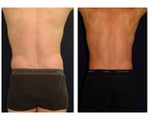 Liposuction