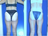 Liposuction