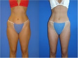 Liposuction