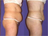 Liposuction