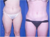 Liposuction