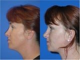 Liposuction
