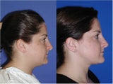 Liposuction