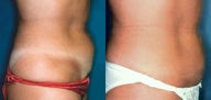 Stomach Lipo