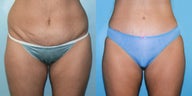 Liposuction & Tummy Tuck