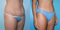 Liposuction & Tummy Tuck