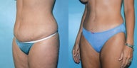 Liposuction & Tummy Tuck