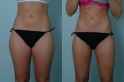 Smart Lipo