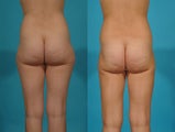 Liposuction