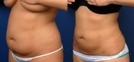 Liposuction Abdomen and Flanks