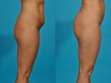 Liposuction, flanks, abdomen